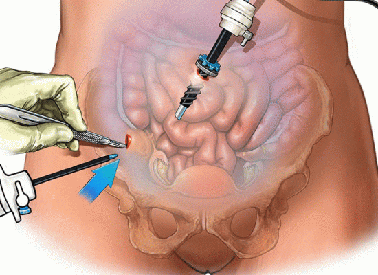 Laparoscopy