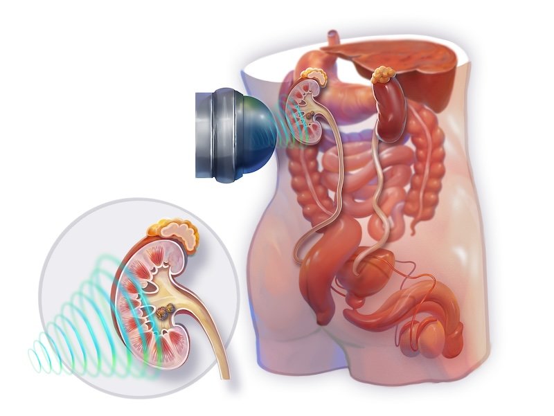 ESWL Shockwave Therapy