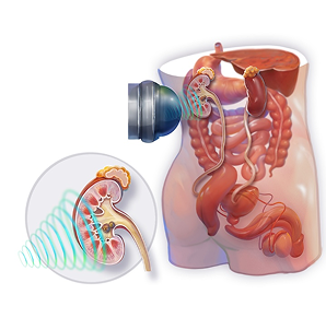 ESWL Treatment