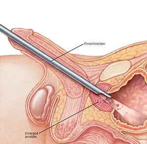 TURP Surgery