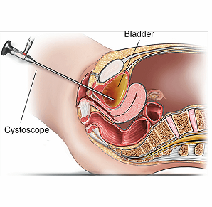 Cystoscopy